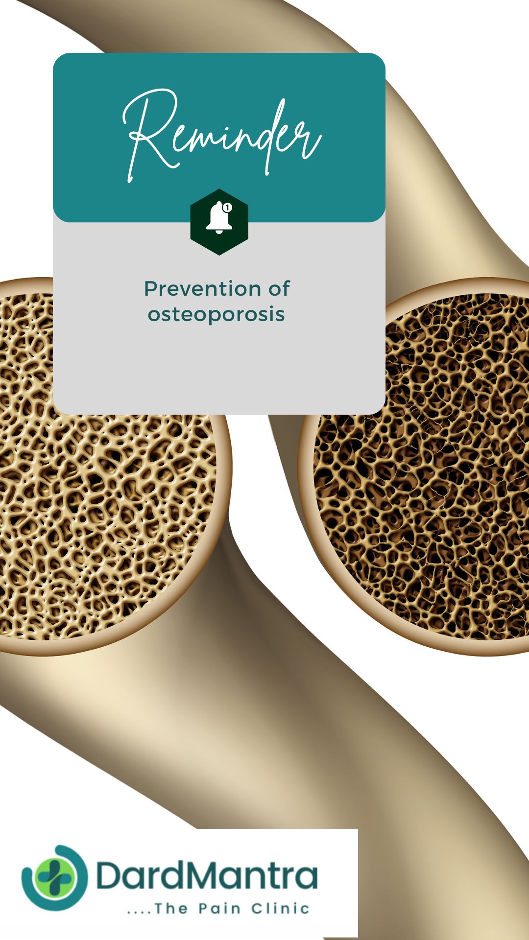 4 ways to prevent Osteoporosis